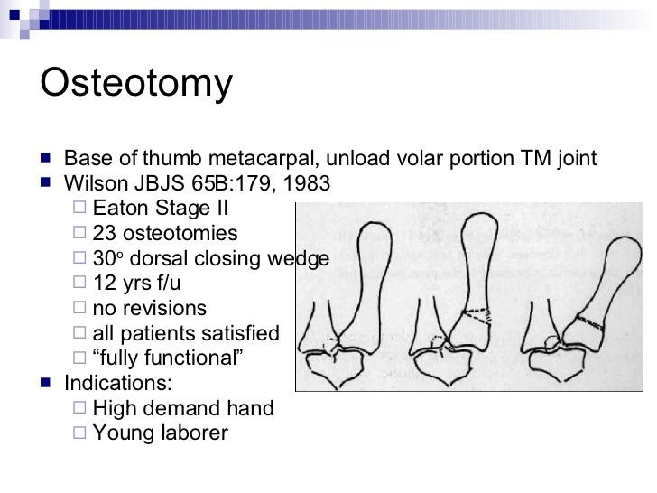 Basal Joint Arthritis Of The Thumb