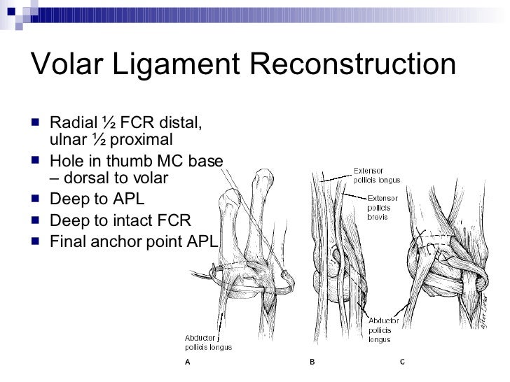 Basal Joint Arthritis Of The Thumb