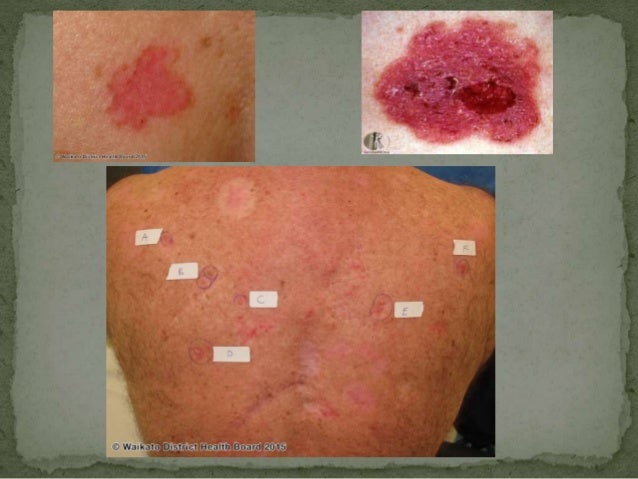 Basal cell carcinoma