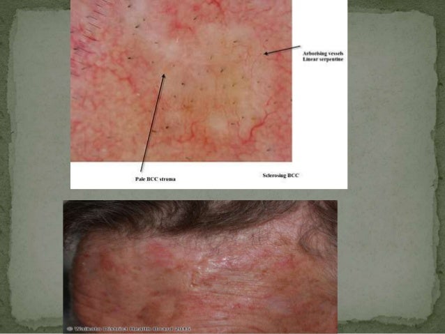 Basal cell carcinoma Basal cell carcinoma