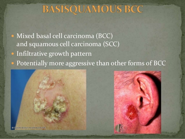 Basal cell carcinoma