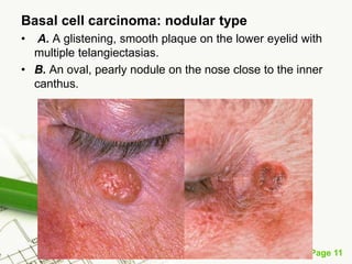 Basal cell carcinoma (BCC)