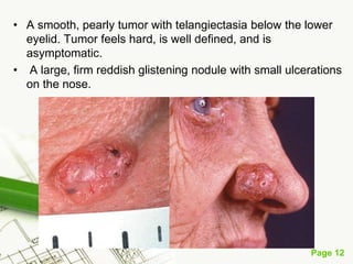 Basal cell carcinoma (BCC)