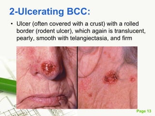 Basal cell carcinoma (BCC)