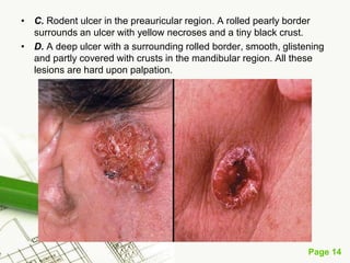 Basal cell carcinoma (BCC)