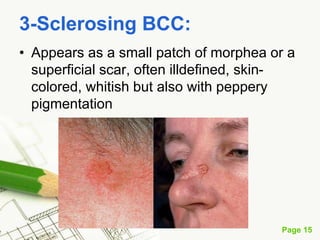 Basal cell carcinoma (BCC)