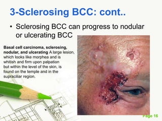 Basal cell carcinoma (BCC)