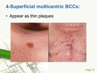 Basal cell carcinoma (BCC)