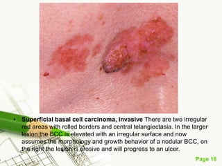 Basal cell carcinoma (BCC)