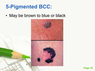 Basal cell carcinoma (BCC)