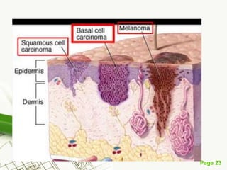 Basal cell carcinoma (BCC)