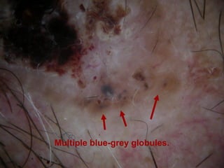 Multiple blue-grey globules.
 