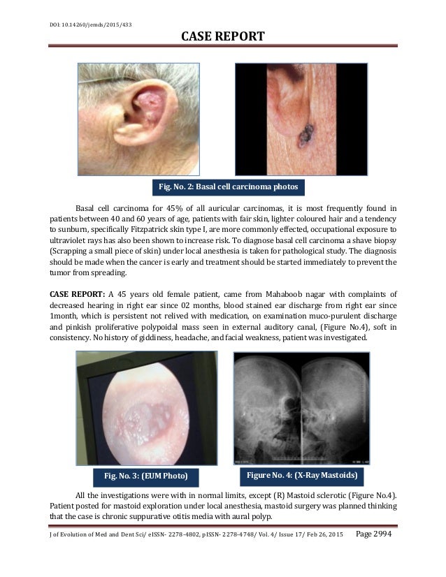 Basal Cell Carcinoma In Middle Ear