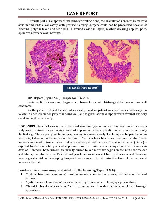 Basal Cell Carcinoma In Middle Ear