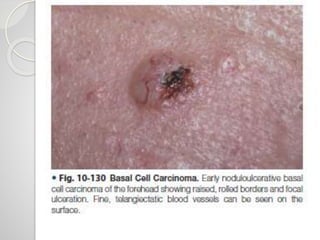 Basal cell carcinoma of oral cavity