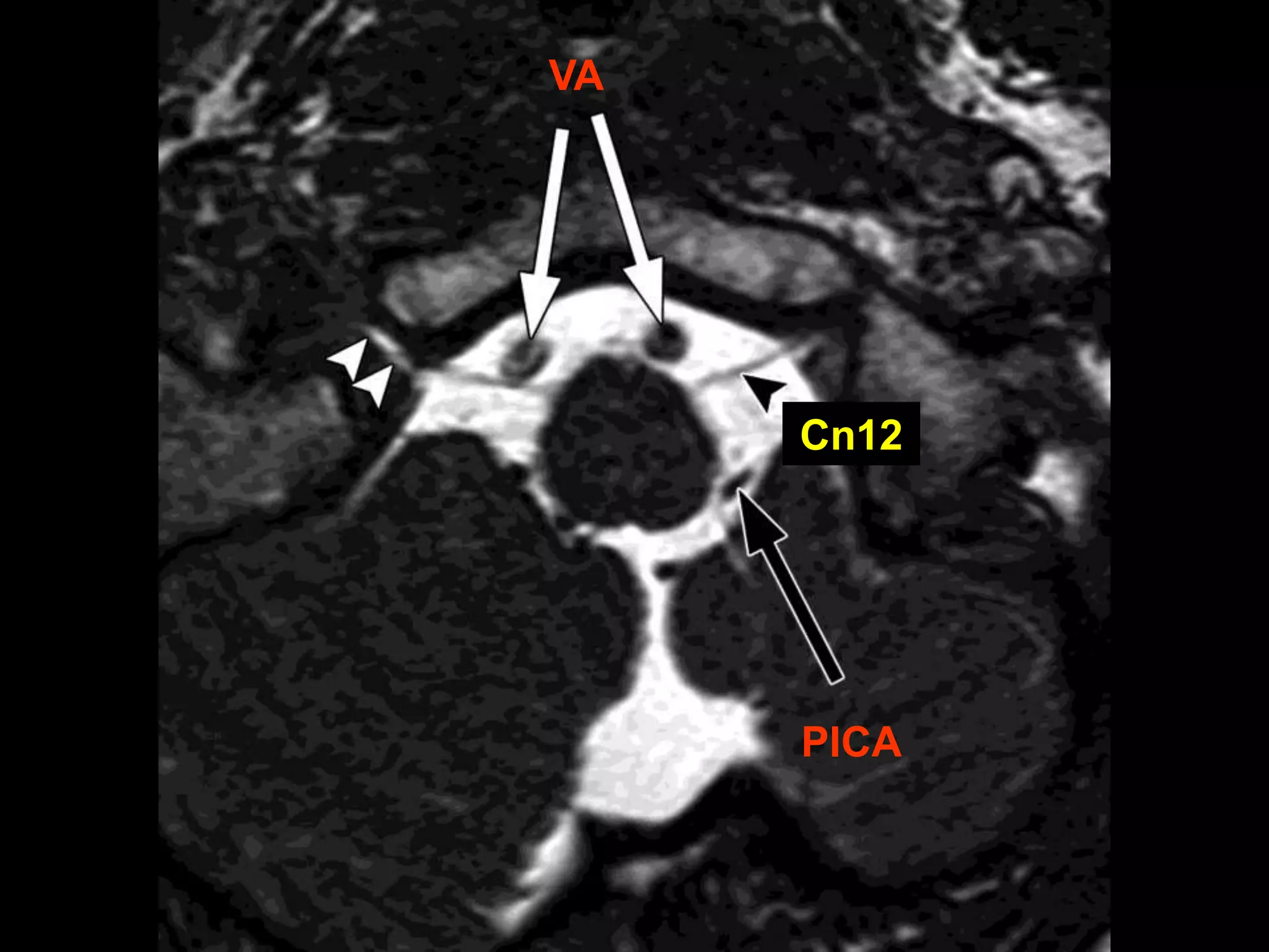 Urgent: Understanding Your Basal Cisterns' Patency - 192lhgj