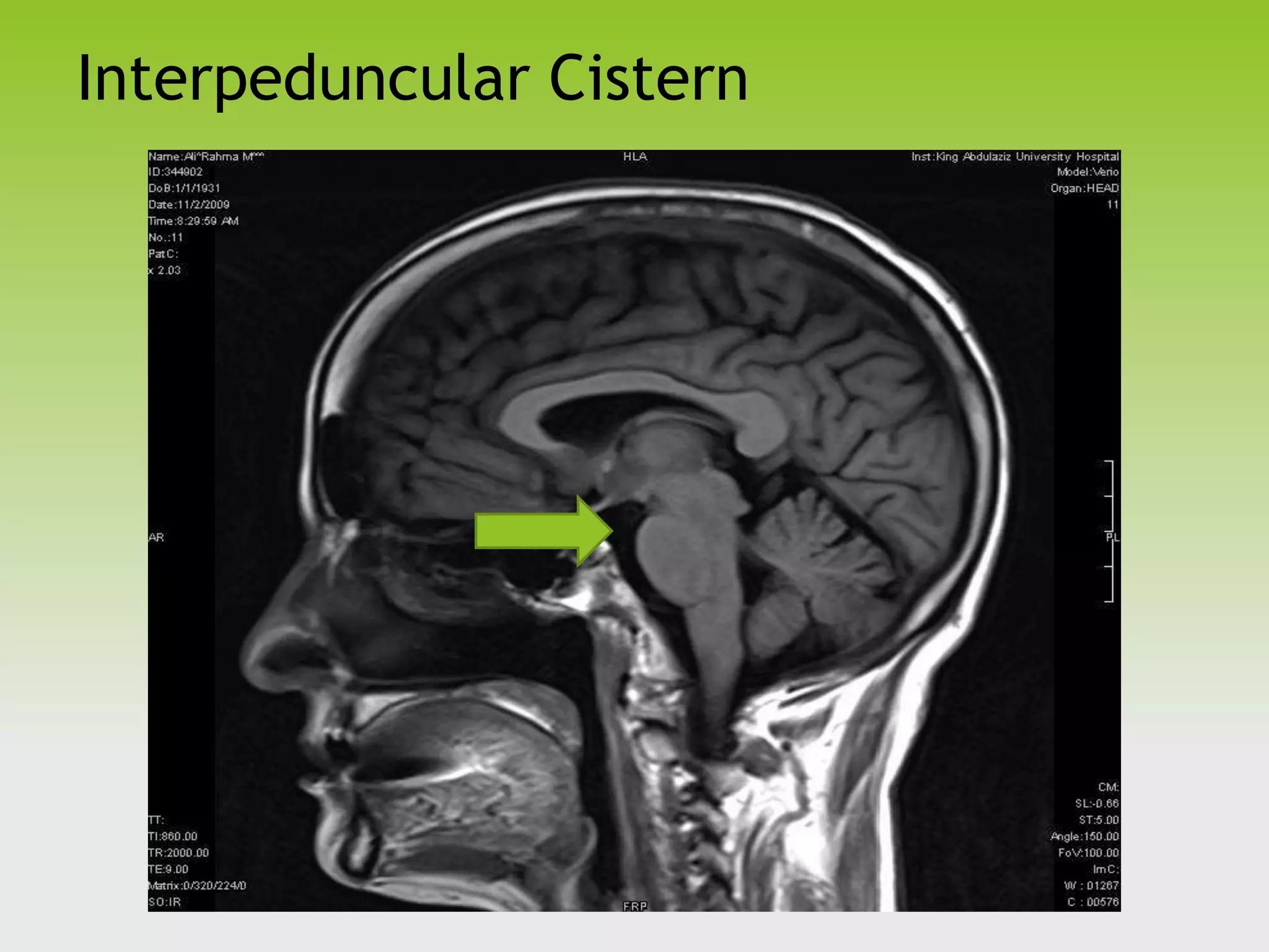 The Critical Role Of Patent Basal Cisterns - j939rd8
