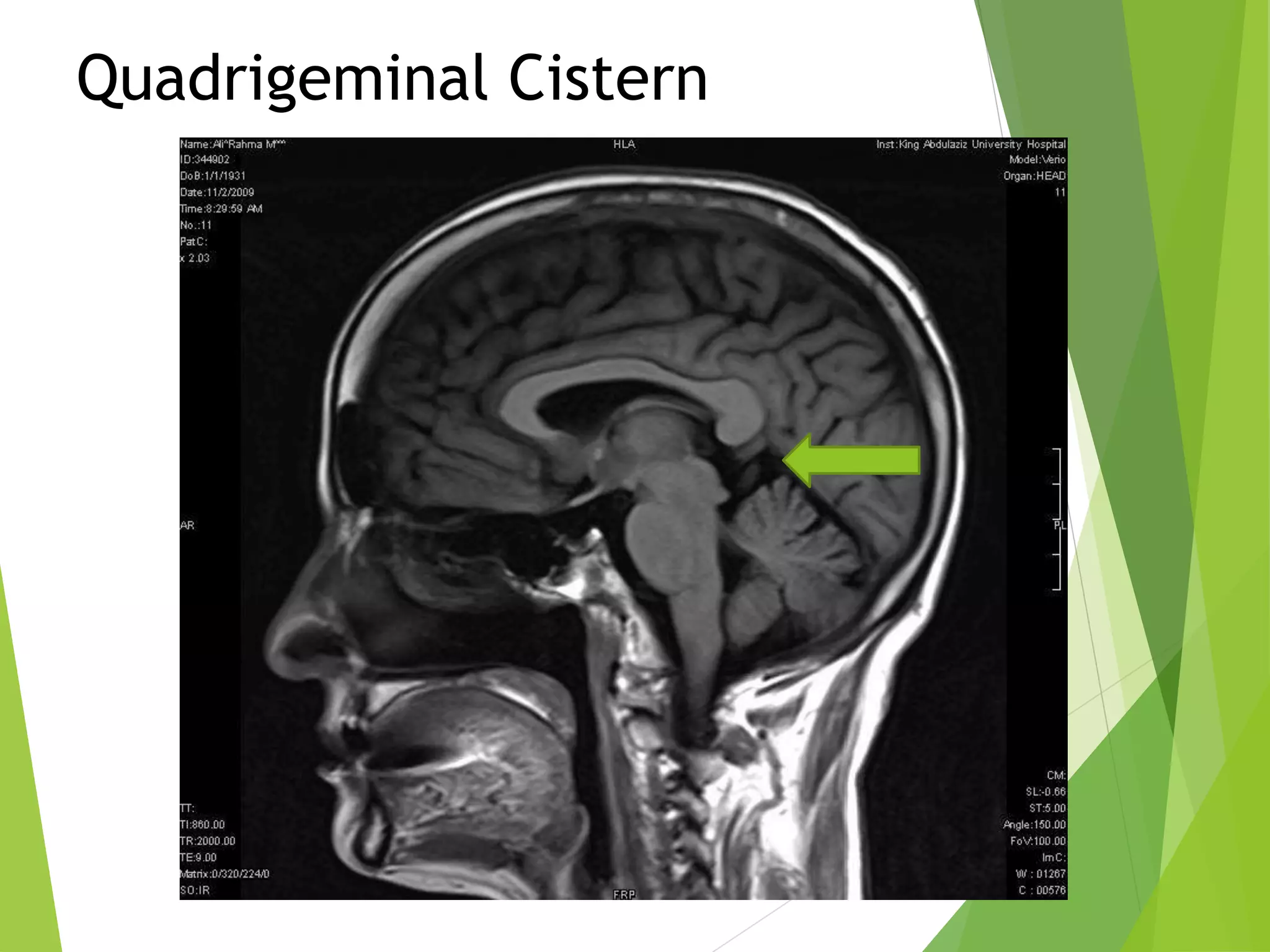 Urgent: Understanding Your Basal Cisterns' Patency - 4pwoadw