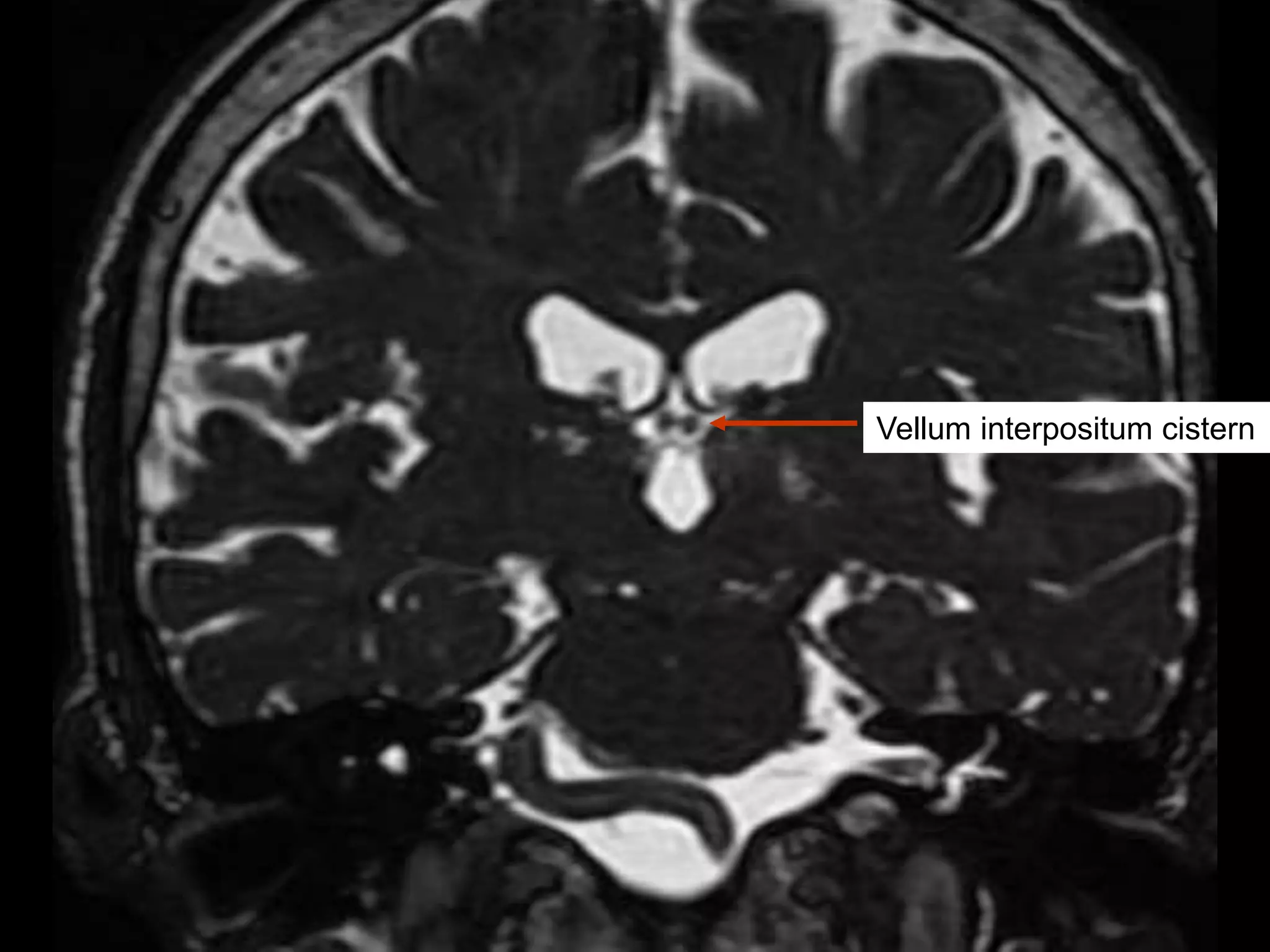 Urgent: Understanding Your Basal Cisterns' Patency - astadha