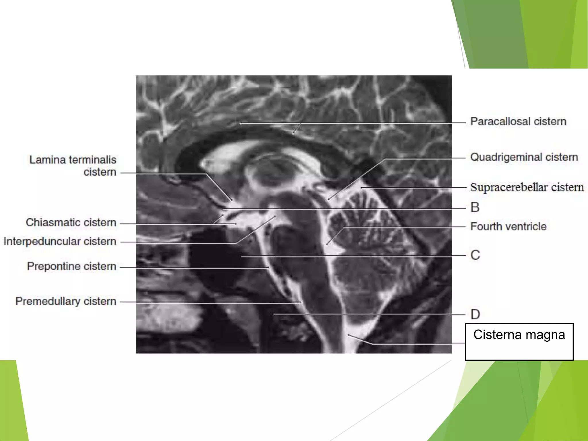 Patent Basal Cisterns:  New Research Reveals Surprising Implications - pinqz2d