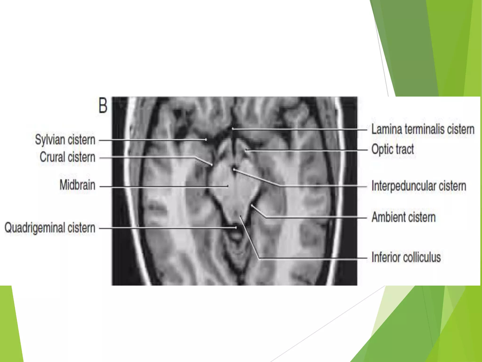 Urgent: Understanding Your Basal Cisterns' Patency - t65g9d5