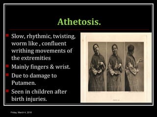 Athetosis.
 Slow, rhythmic, twisting,
worm like , confluent
writhing movements of
the extremities
 Mainly fingers & wrist.
 Due to damage to
Putamen.
 Seen in children after
birth injuries.
Friday, March 4, 2016
 