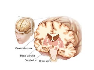 Progressive supranuclear palsy Progressive supranuclear palsy
