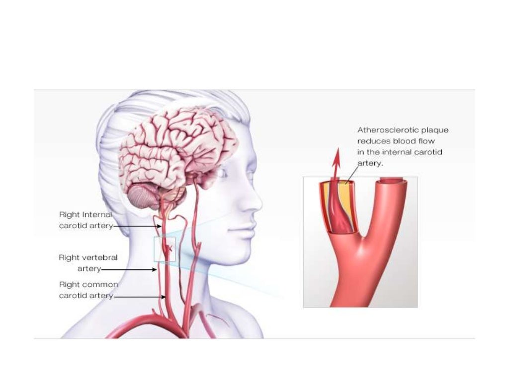 Basal ganglia stroke