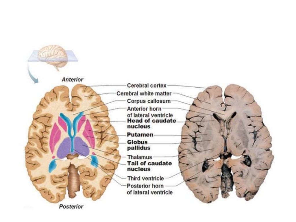 Basal ganglia stroke