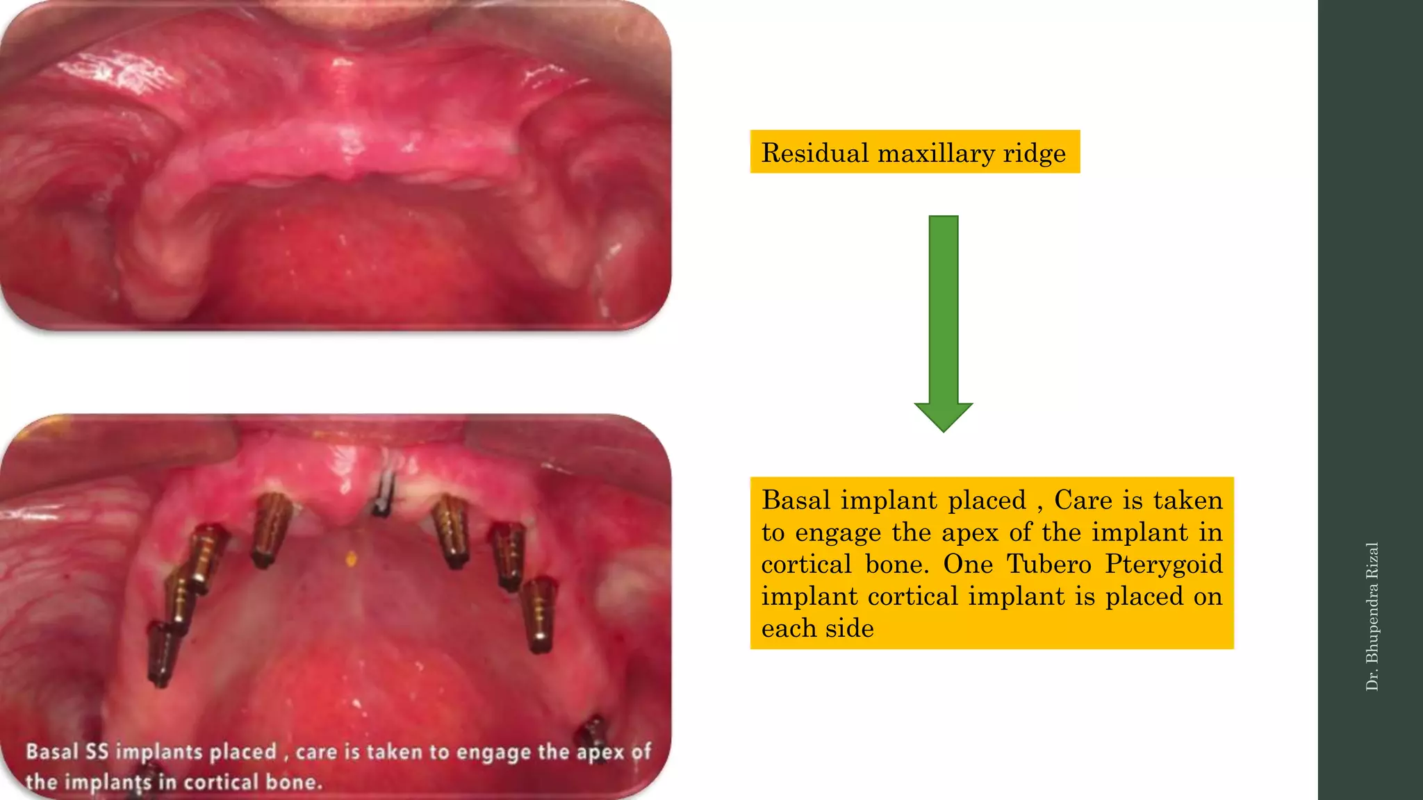 Basal implant - a newer variety of implant system | PPTX