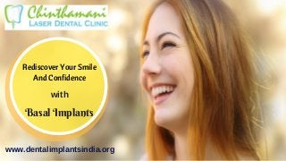 Basal Implants
Rediscover Your Smile
And Confidence
with
www.dentalimplantsindia.org
 