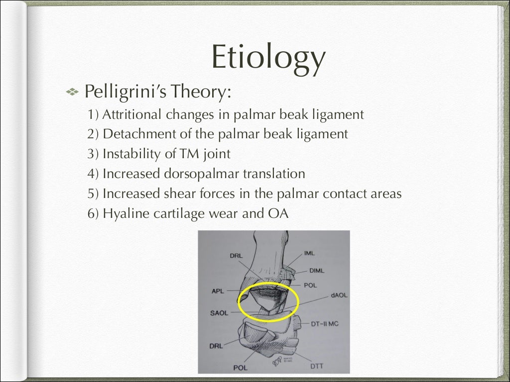 Basal joint arthritis presentation