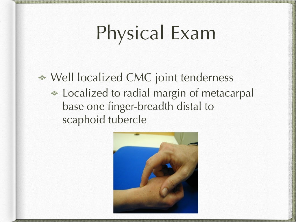 Basal joint arthritis presentation