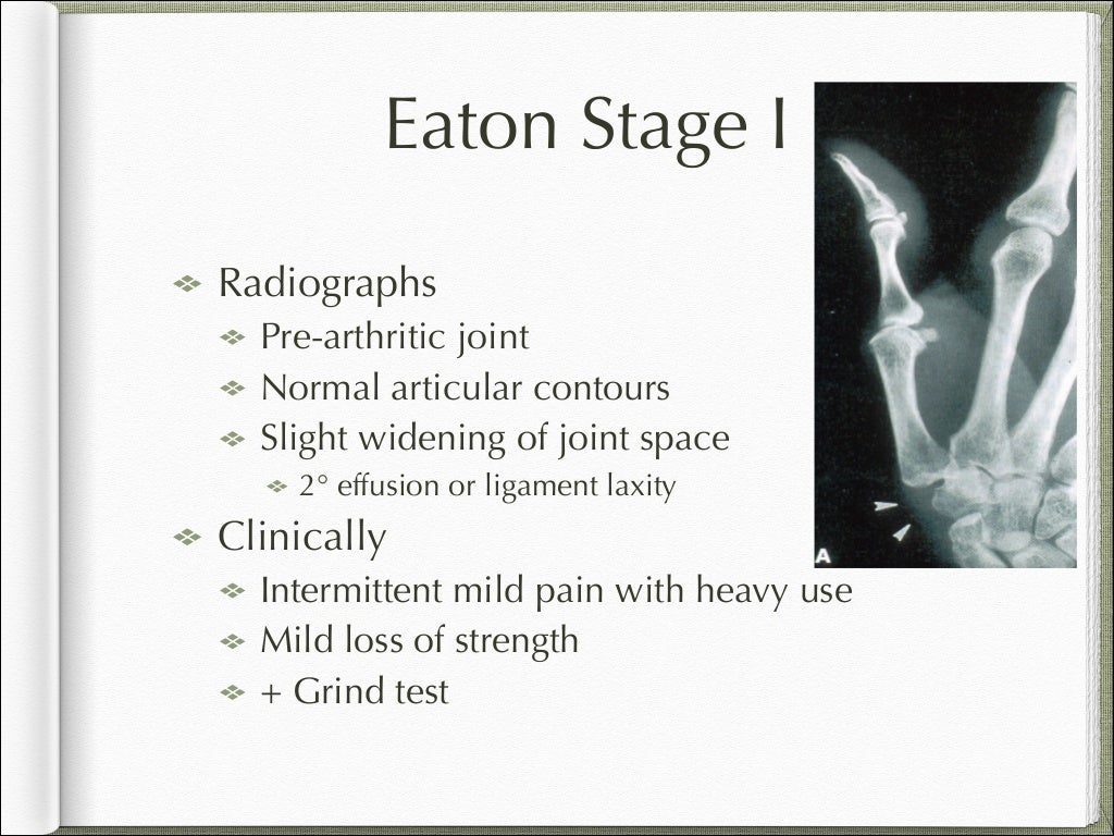 Basal joint arthritis presentation