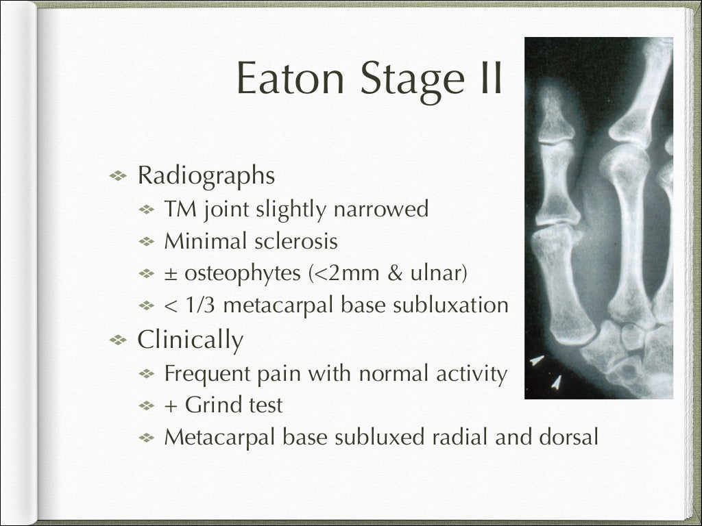 Basal joint arthritis presentation