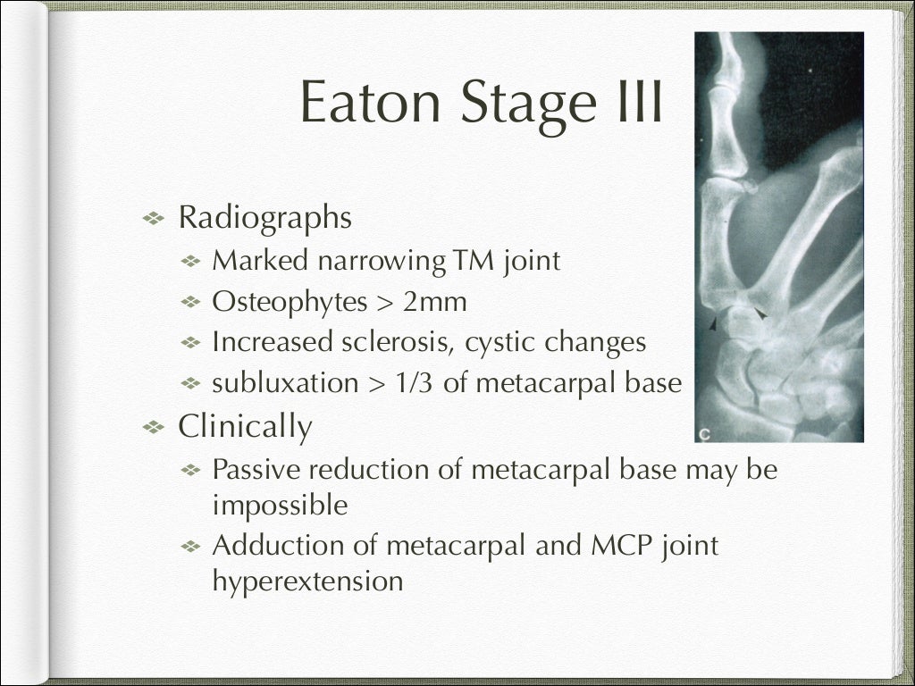 Basal joint arthritis presentation