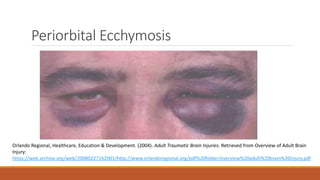 Periorbital Ecchymosis
Orlando Regional, Healthcare, Education & Development. (2004). Adult Traumatic Brain Injuries. Retrieved from Overview of Adult Brain
Injury:
https://web.archive.org/web/20080227162001/http://www.orlandoregional.org/pdf%20folder/overview%20adult%20brain%20injury.pdf
 