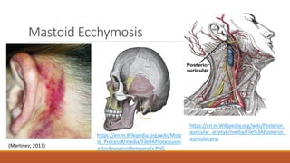 Mastoid Ecchymosis
https://en.m.Wikipedia.org/wiki/Msto
id_Process#/media/File#AProcessusm
astoideusossisttemporalis.PNG
https://en.m.Wikipedia.org/wiki/Posterior_
auricular_artery#/media/File%3APosterior_
auricular.png
(Martinez, 2013)
 