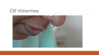 CSF rhinorrhea
 