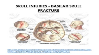 https://www.google.co.uk/search?q=Skull+injuries+basilar+skull+fracture&source=lnms&tbm=isch&sa=X&ved=
0ahUKEwjq177DzIDOAhWNNpQKHbOACZkQ_AUICQ#imgrc=Jr3kbp4ggTPcwM%3A
 