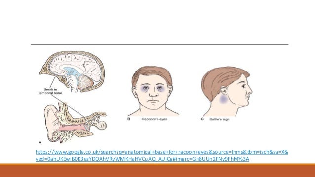 Basal skull fractures