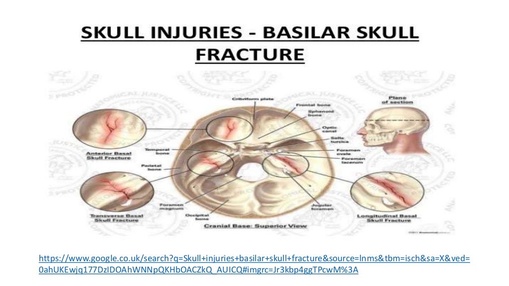 Basal skull fractures