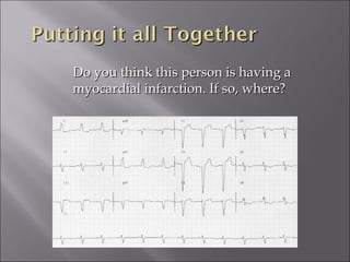 Do you think this person is having aDo you think this person is having a
myocardial infarction. If so, where?myocardial infarction. If so, where?
 
