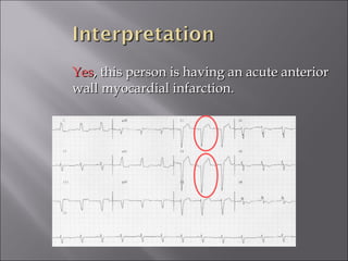 YesYes, this person is having an acute anterior, this person is having an acute anterior
wall myocardial infarction.wall myocardial infarction.
 