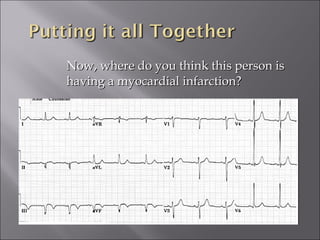 Now, where do you think this person isNow, where do you think this person is
having a myocardial infarction?having a myocardial infarction?
 