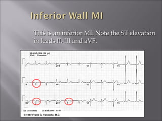 This is an inferior MI. Note the ST elevationThis is an inferior MI. Note the ST elevation
in leads II, III and aVF.in leads II, III and aVF.
 
