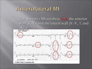 This person’s MI involvesThis person’s MI involves bothboth the anteriorthe anterior
wall (Vwall (V22-V-V44) and the lateral wall (V) and the lateral wall (V55-V-V66, I, and, I, and
aVL)!aVL)!
 