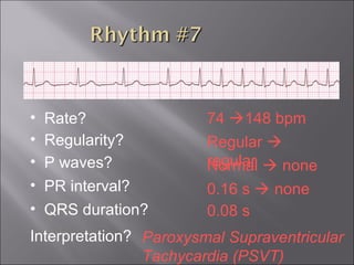 74 148 bpm• Rate?
• Regularity? Regular 
regularNormal  none
0.08 s
• P waves?
• PR interval? 0.16 s  none
• QRS duration?
Interpretation? Paroxysmal Supraventricular
Tachycardia (PSVT)
 
