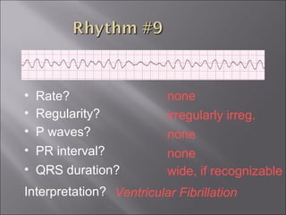 none• Rate?
• Regularity? irregularly irreg.
none
wide, if recognizable
• P waves?
• PR interval? none
• QRS duration?
Interpretation? Ventricular Fibrillation
 