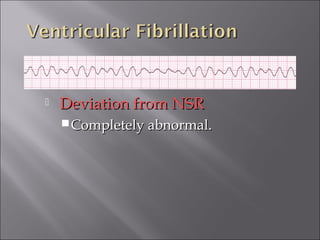  Deviation from NSRDeviation from NSR
Completely abnormal.Completely abnormal.
 